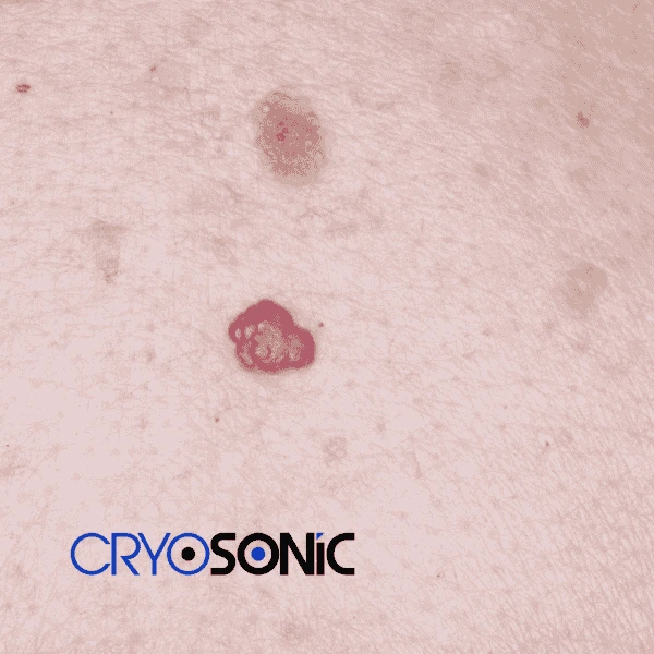Looking for pain free cherry angioma removal treatment Wootton-Bassett? Call our team today! Wootton-Bassett