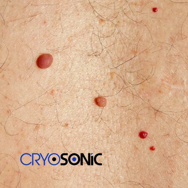 get cherry angioma removal treatment today! Wootton-Bassett