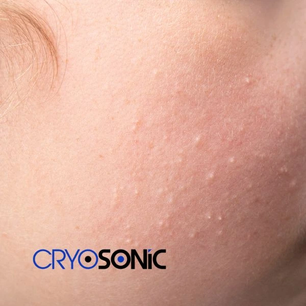Are you looking for milia removal treatment? Contact our team today Wootton-Bassett