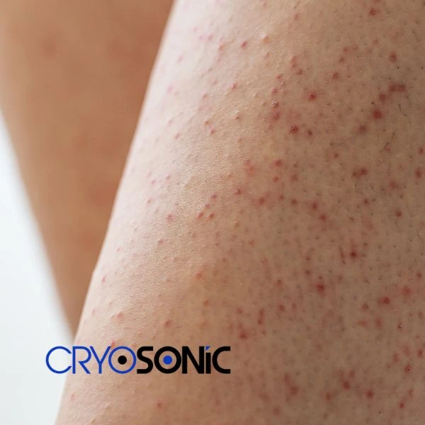 Looking for Seborrhoeic Keratosis removal Wootton-Bassett treatment? Call our consultants today in Wootton-Bassett