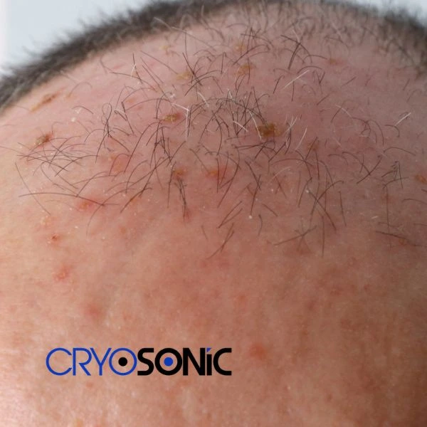 Access Seborrhoeic Keratosis removal from the comfort of your own home! Call us today in Wootton-Bassett