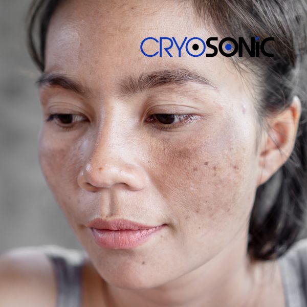 Ready to start age spots removal? Contact our team today in Wootton-Bassett