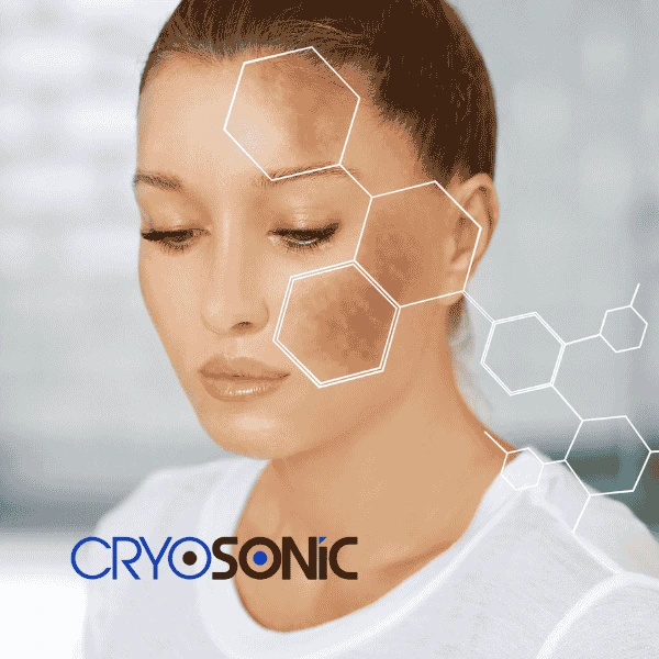 Are you looking for age spot removal treatment? Contact Cryosonic today in Wootton-Bassett