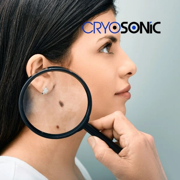 Do you want to learn more about benign moles removal treatment? Call our team today Wootton-Bassett