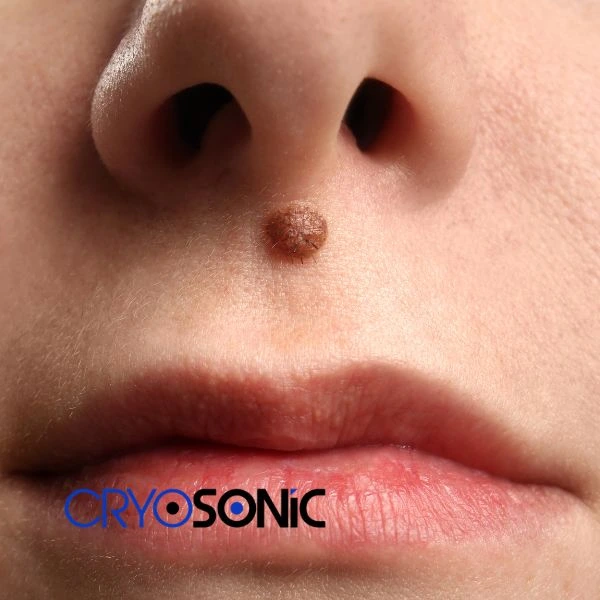 Start your benign moles removal treatment today Wootton-Bassett