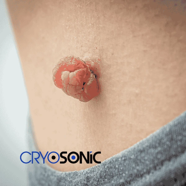Book your skin tags removal Wootton-Bassett from comfort of your own home! Wootton-Bassett