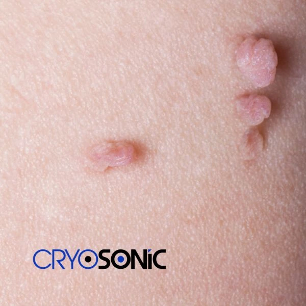 Are you looking for fast effect skin tag removal Wootton-Bassett? Book in NOW! Wootton-Bassett