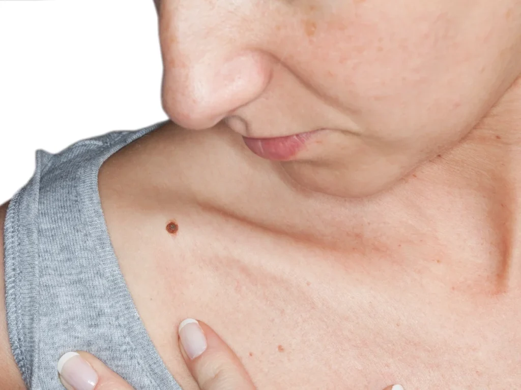 How Does CryoPen Sun Damage Treatment Wootton-Bassett Work? Wootton-Bassett