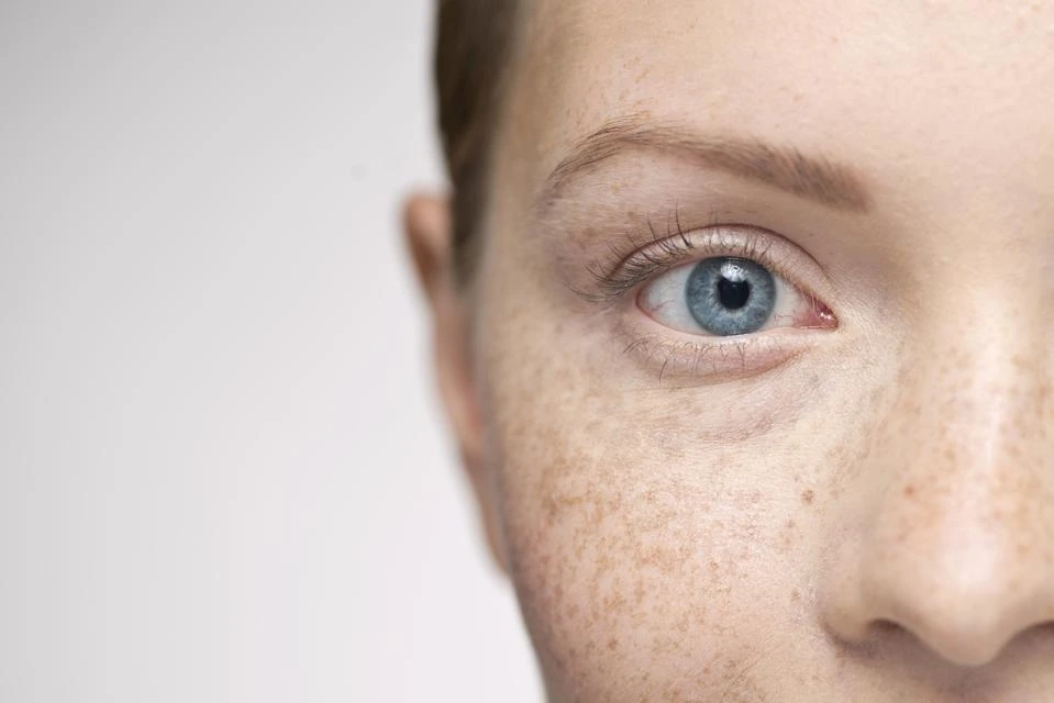 Understanding Sun Damage: How UV Rays Alter Skin and How CryoPen Can Reverse It Wootton-Bassett