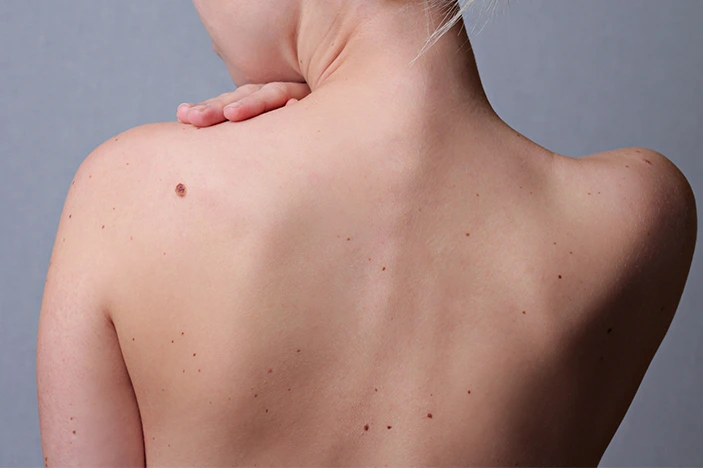 The Skin&rsquo;s Healing Journey After CryoPen Sun Damage Treatment Wootton-Bassett