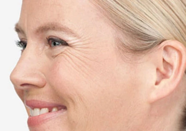 CryoPen Precision vs. Laser: Which Is Better for Sun-Damaged Skin? Wootton-Bassett