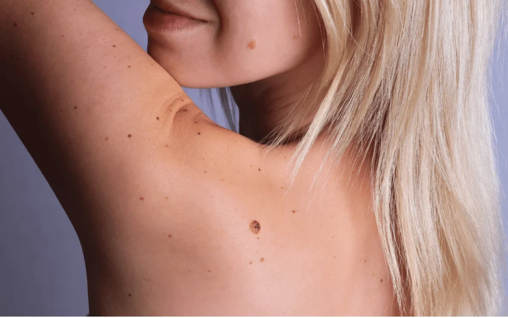 What Are Sun Spots and Pigmentation Wootton-Bassett? Wootton-Bassett