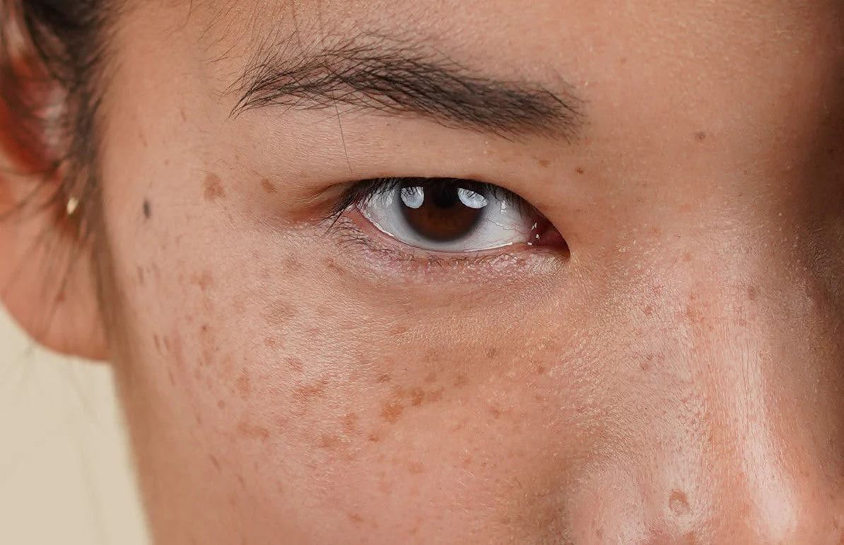 Is There Any Risk of Scarring or Pigmentation Wootton-Bassett? Wootton-Bassett