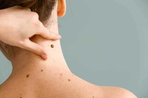 Who Should Avoid CryoPen Treatments? Wootton-Bassett