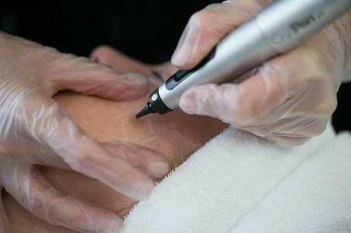 The CryoPen Technology Explained: How Extreme Cold Removes Sun-Damaged Skin Cells Wootton-Bassett