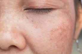 CryoPen Precision vs. Laser: Are Both Treatments Safe? Wootton-Bassett