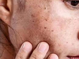 Why CryoPen Works Best for Isolated Sun Spots and Pigmentation Wootton-Bassett