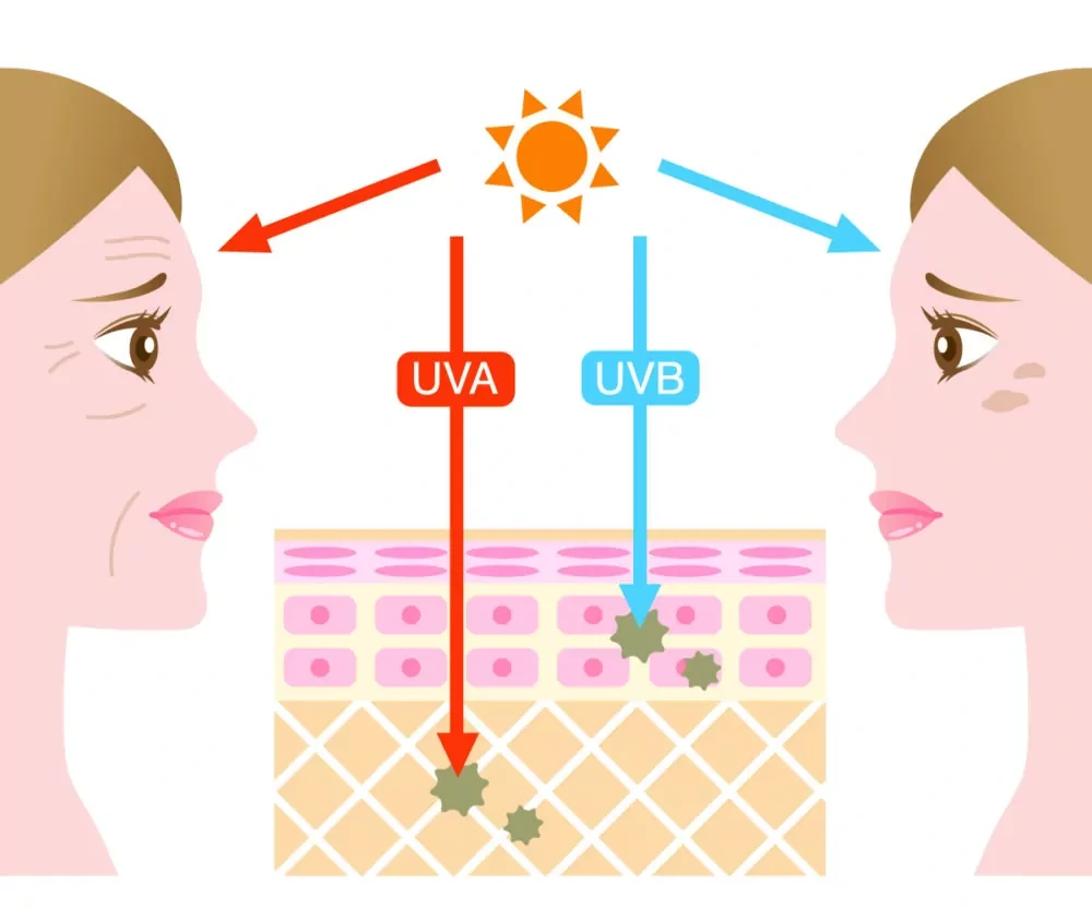 Understanding Sun Damage Wootton-Bassett - Why Should Sun Damage Be Treated Early? Wootton-Bassett